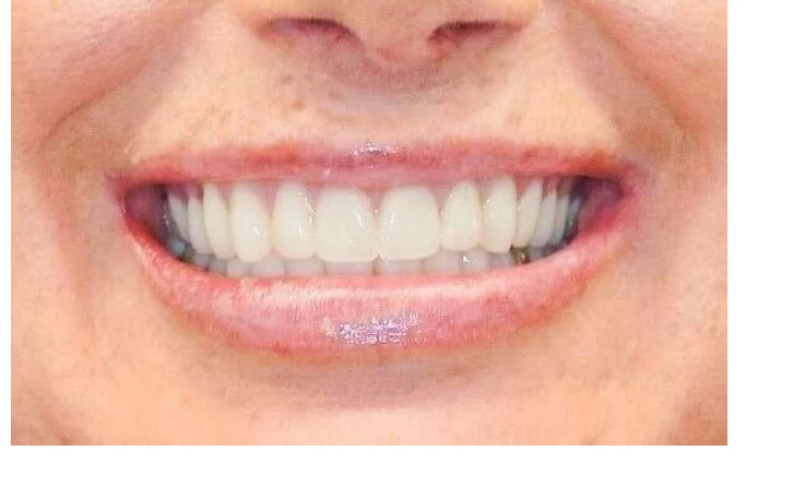 After single dental implant
